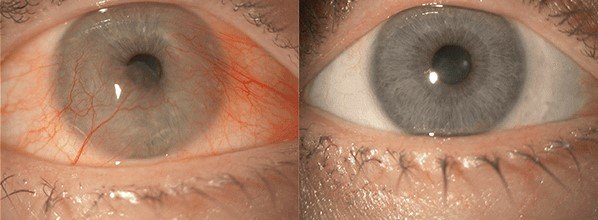 With a new procedure, Dr. Gulani is able to restore white eyes to patients whose eyes have red and yellow growths due to being in the sun too much.